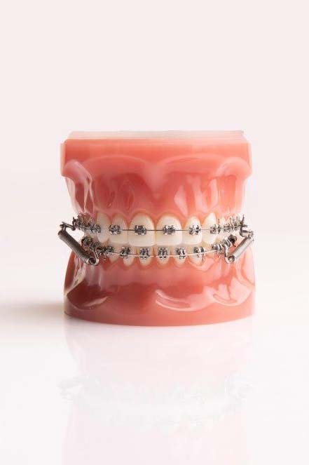Klasse functionele apparatuur - Orthodontie Schreurs